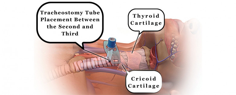Tracheostomy Tube Change At Home