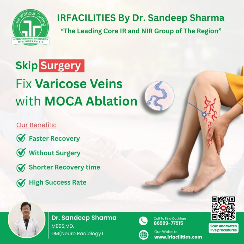 Varicose Veins Treatment
