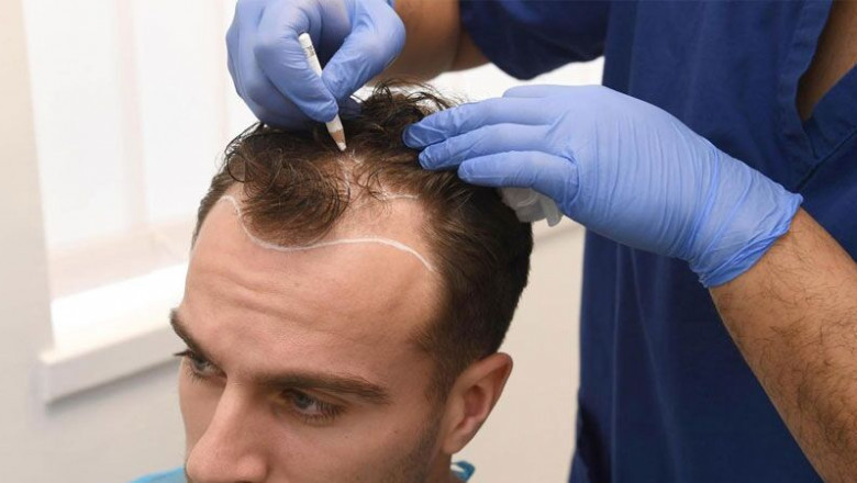 Is it Possible to Get a Discount on Hair Transplants in Dubai During Special Promotions?