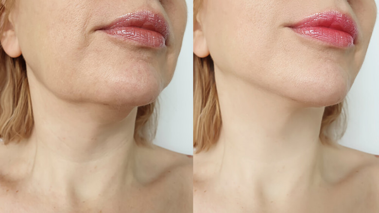 Chin Liposuction in Chicago: Chiseling a Characterized Facial structure