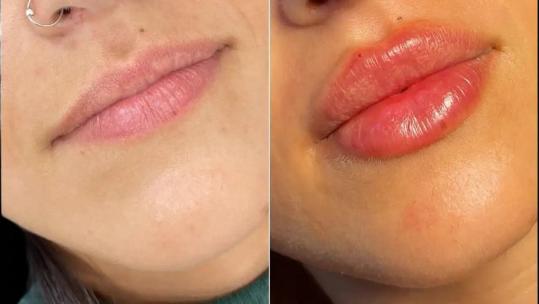 Lip Filler Myths: Best Aesthetic Clinic in Dubai