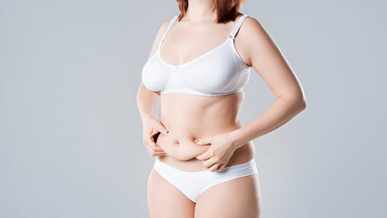 What is Diastasis Recti – How Can a Tummy Tuck Help?