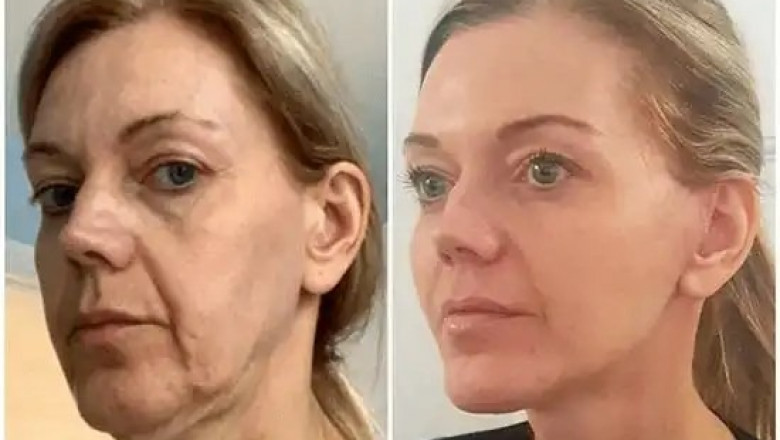 Profhilo Treatment in Dubai Pioneering the Future of Skin Perfection