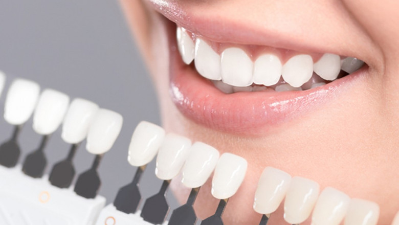 Uncover the Impact of Dental Veneers on Your Appearance