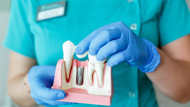Dental Implant Education: Advancing Skills for Successful Implant Procedures