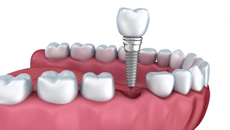 Reclaiming Your Smile: Dental Implants Near Baker, LA