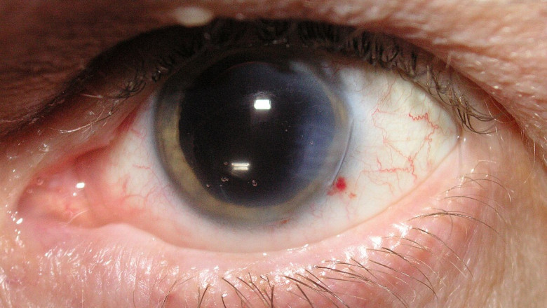 Innovations in Cataract Surgery That Are Transforming Vision Care for Patients
