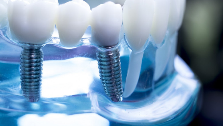 Same Day Dental Implants in Cary, NC: A Faster Path to a Beautiful Smile