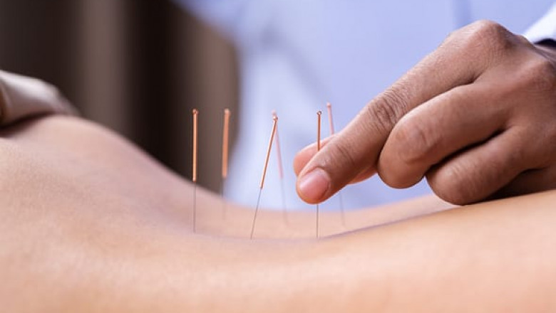 Can Acupuncture Fix a Pinched Nerve? Safety, Forbidden Points, and Weight Loss Ear Seeds Explained