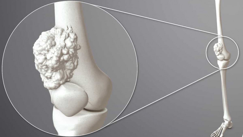 Rising Incidence of Bone Metastasis in Solid Tumors Market Drive Innovation in Therapeutics