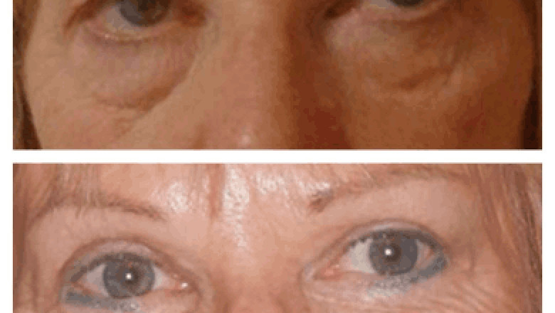 Eye bag removal in Dubai: Signs It's Time to Consider Treatment