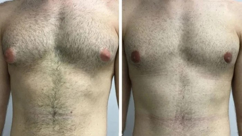 Gynecomastia in Dubai: Best Surgeons and Clinics for Effective Treatment