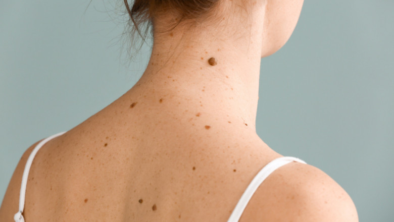 The Complete Process of Birthmark Removal in Dubai Explained