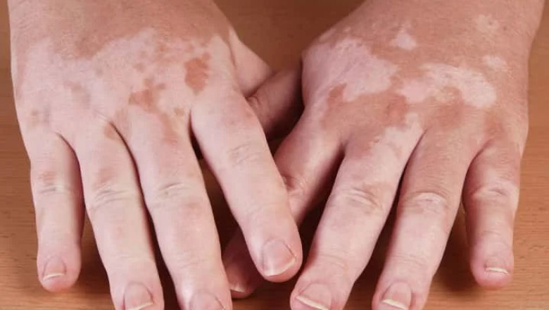 Phototherapy for Vitiligo: Benefits, Risks, and What to Expect