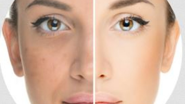 How to Choose the Right Skin Whitening Treatment in Punjab?
