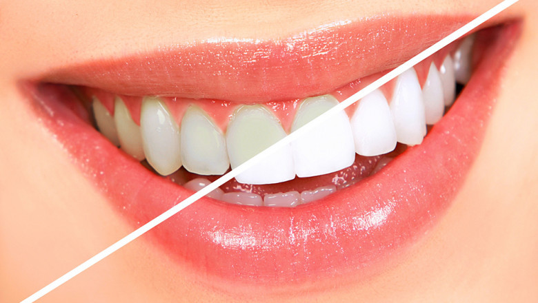 What to Expect from Teeth Whitening Treatments in Dubai