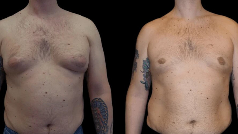 5 Key Factors to Consider When Selecting the Best Gynecomastia Surgeon in dubai