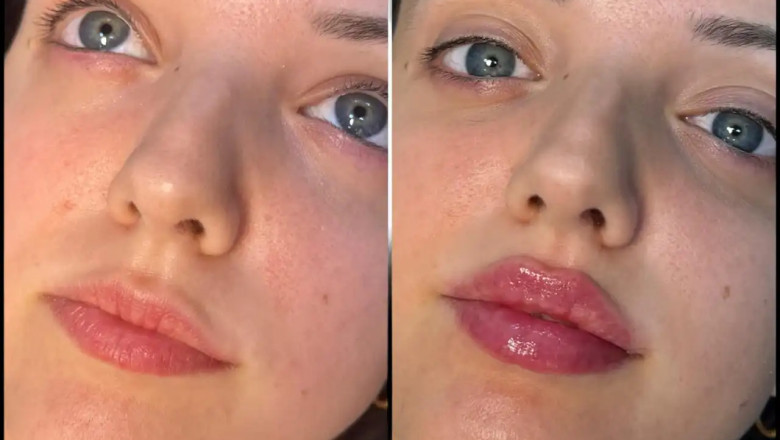 Best Doctors in dubai for Fillers: Non-Surgical Facial Contouring Solutions