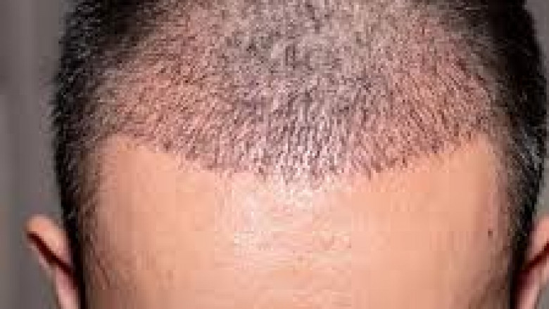 Discover the Best Hair Transplant in Gurgaon, Noida & Lucknow with Dr. Amit Gupta for Natural, Permanent Results