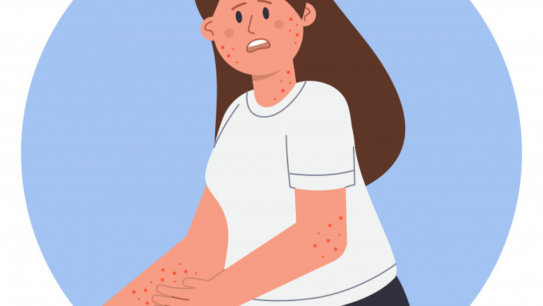 Psoriasis and Diet: What to Eat & What to Avoid