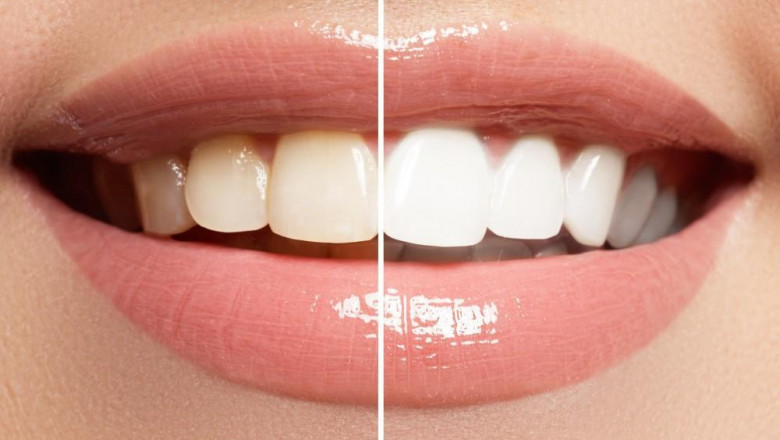 Teeth Whitening in Dubai: Safe & Proven Methods