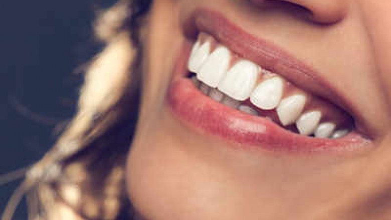 Long-Lasting Teeth Whitening Results in Dubai