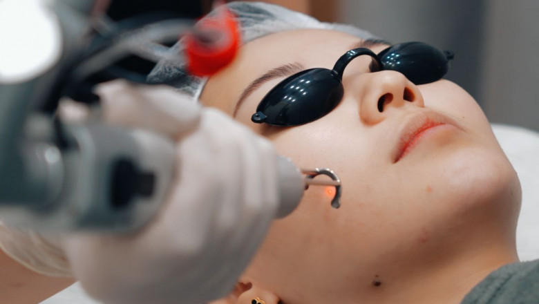 Achieve a Perfect Complexion with Pico Laser Treatment