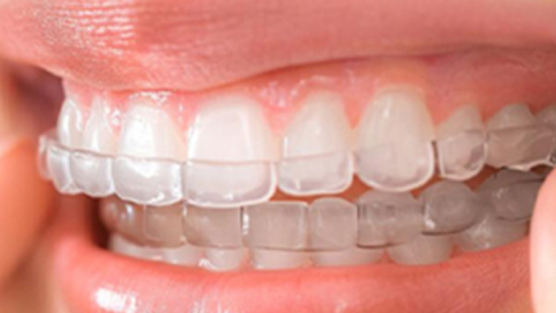 Invisalign Braces: Clear, Comfortable, and Effective Treatment