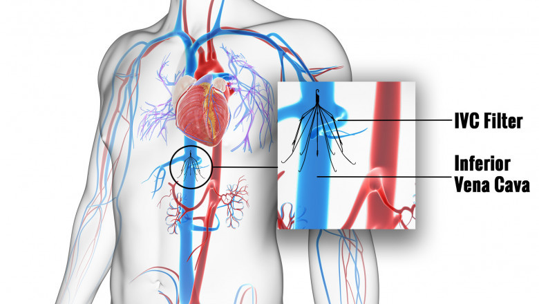Understanding Inferior Vena Cava (IVC) Filters: Function, Uses, and Benefits