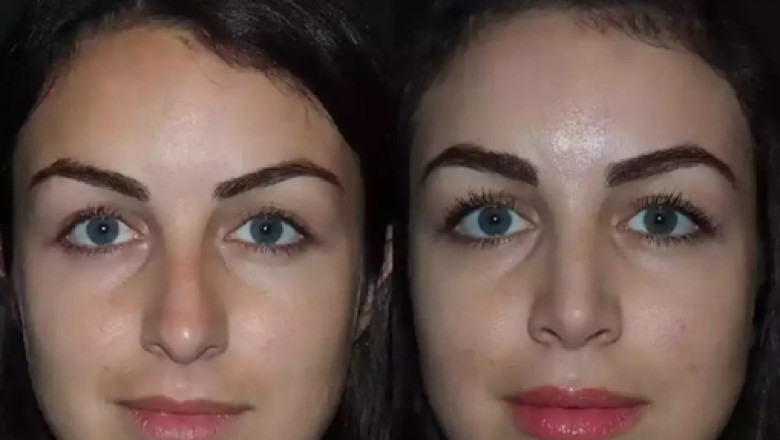 Best Rhinoplasty Surgeons in Dubai: Achieve the Perfect Nose Shape