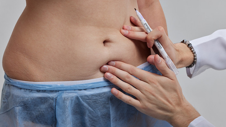 Sculpt Your Dream Waistline with a Tummy Tuck in Dubai, Anytime