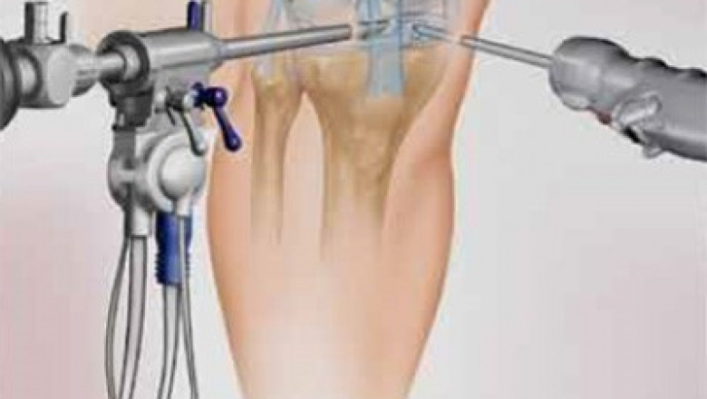 Arthroscopy Devices Market Growth Potential And Key Opportunities In The Coming Years