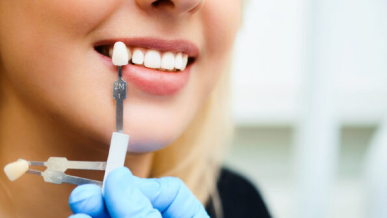 Why Should You Consider Full Mouth Dental Implants?