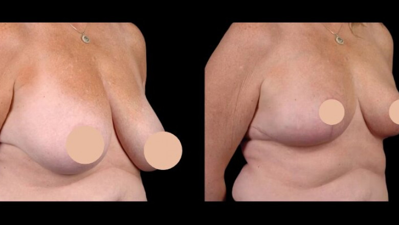 Best Breast Reduction Surgeon in dubai: Patient Success Stories