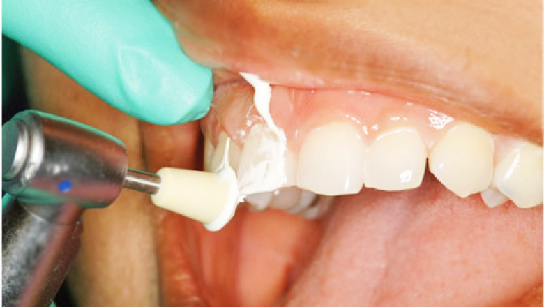 Dental Hygienist Careers: How to Become One and What to Expect