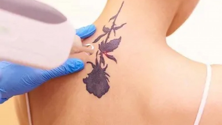 Tattoo Removal in Dubai: Safety and Regulations