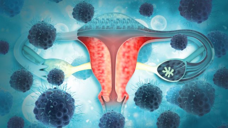 The Role of Personalized Medicine in the Clear Cell Ovarian Cancer Market