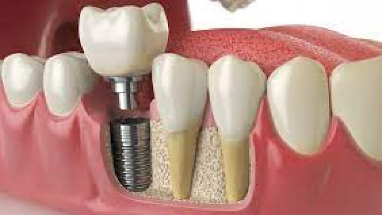 A Lifelong Smile, Understanding Dental Implants