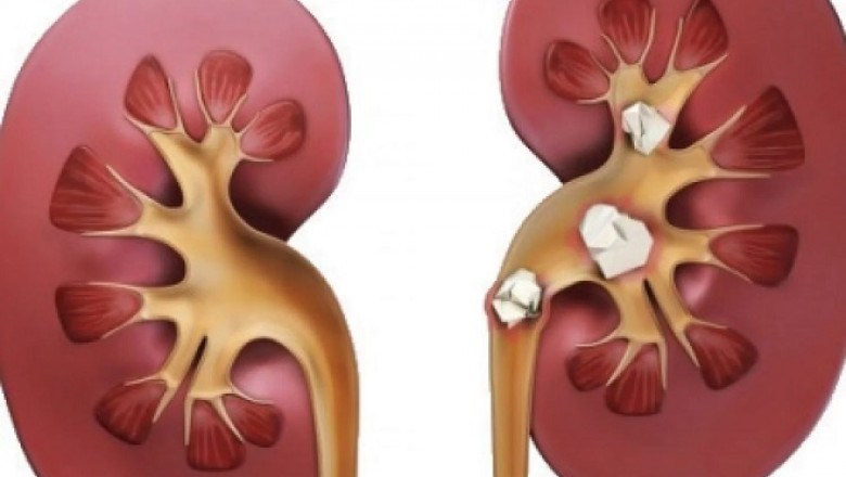 Ayurvedic Treatment For Kidney Stone: Detoxify and Cleanse Your Kidneys Naturally