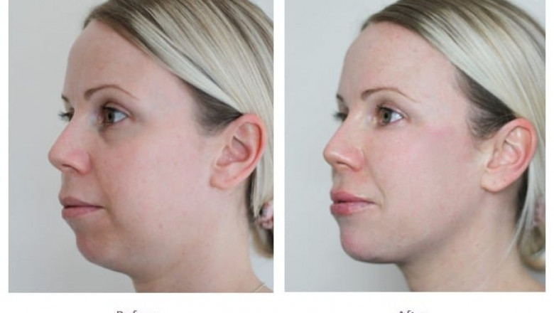 Get a Chiseled Jawline with Advanced Jawline Fillers Treatments in Dubai