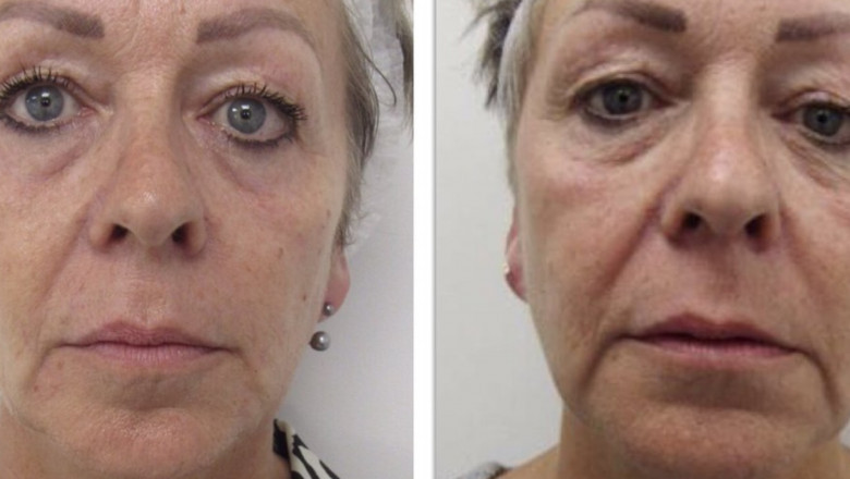 How Face Lifting Threads Work: Benefits, Costs, and Recovery