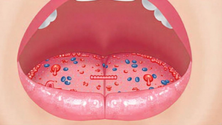 Stages of Oral Cancer: Understanding the Progression | Oncare Cancer