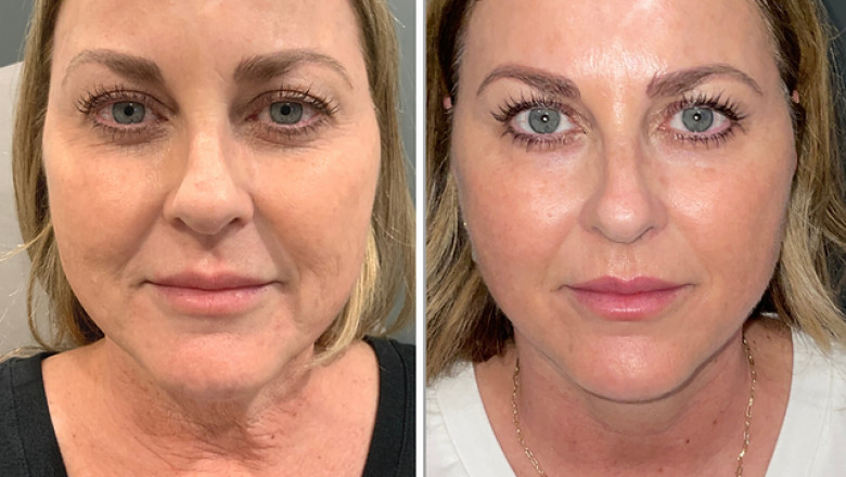 What Are the Top Benefits of Fractional CO2 Laser Treatment for Younger Skin?