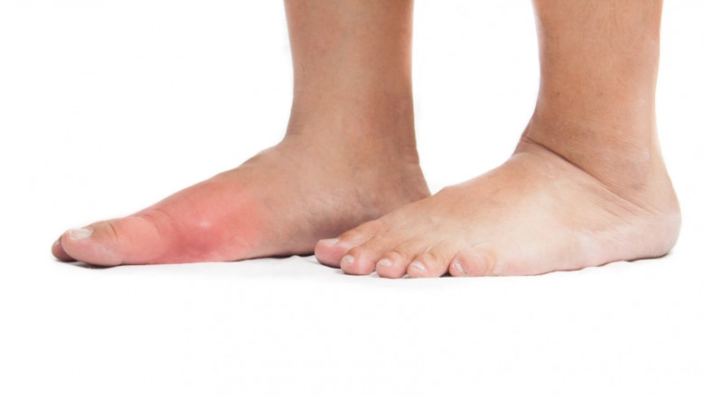 Charcot Foot Treatment: Causes, Symptoms, and Best Treatment Options