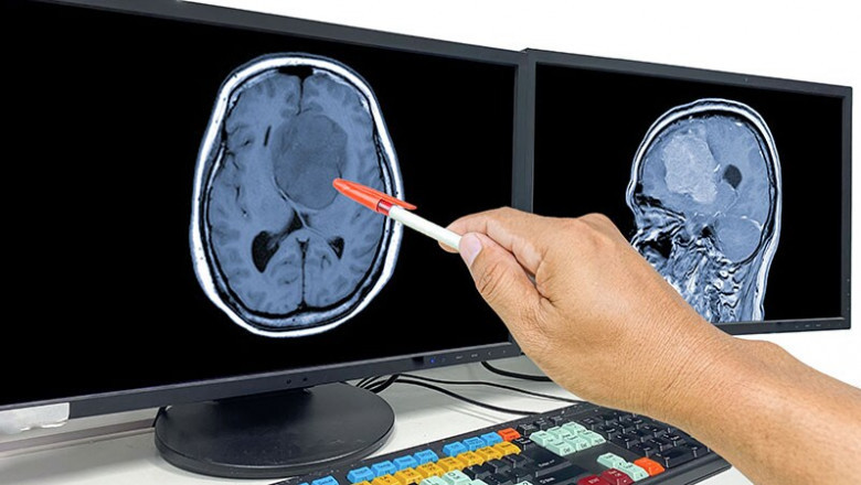 Pharmaceutical Development in Glioblastoma Market Will Foster Innovation to Improve Survival Rates