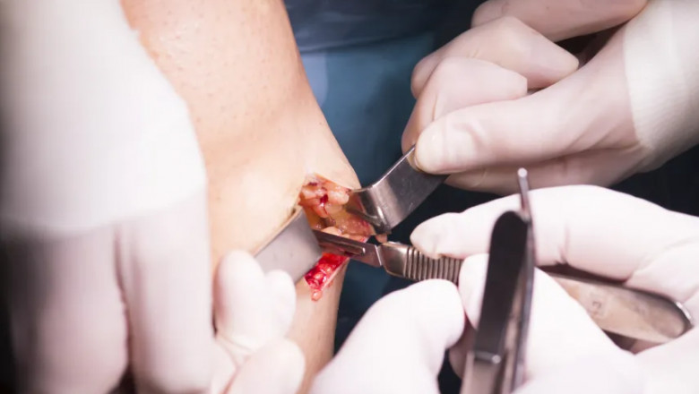 What Is Wound Debridement and When Is It Necessary?