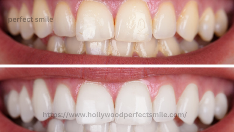 The Pros and Cons of Hollywood Teeth Whitening: Is It Worth It?
