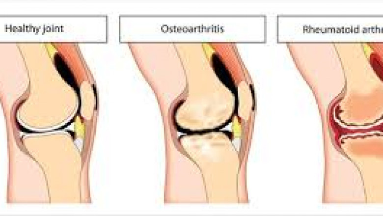 Osteoarthritis vs. Rheumatoid Arthritis: Understanding the Differences and Treatment Options