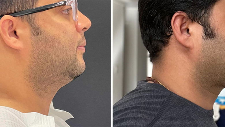 Chin Liposuction Chicago: Define Your Jawline with Precision Fat Removal