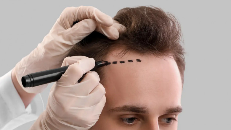 How Safe Are Hair Transplants in Islamabad?